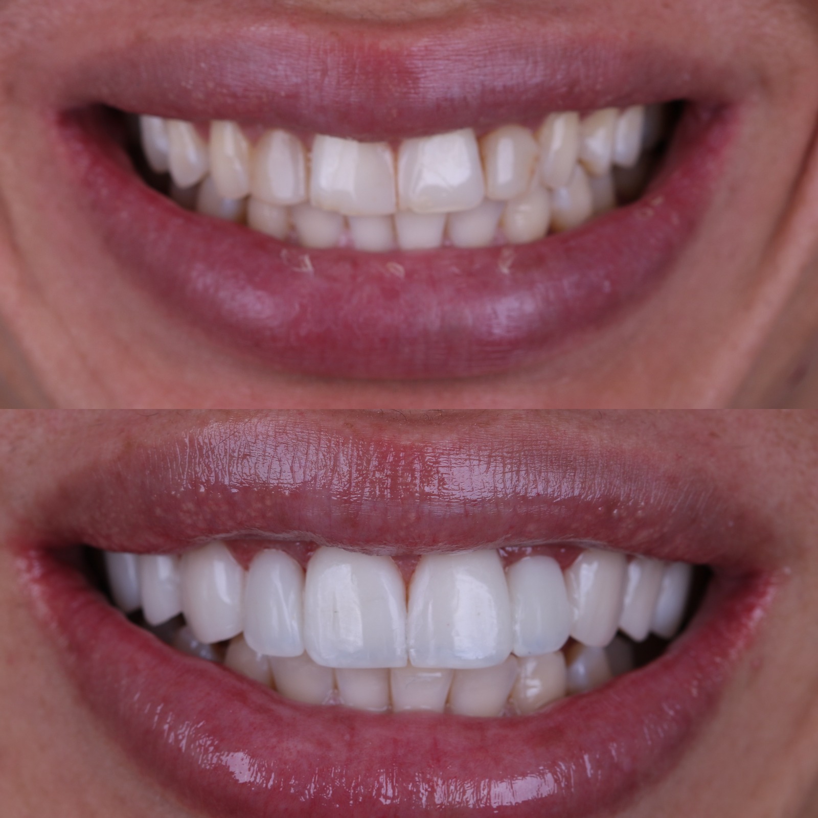 Resultado de lentes de contato dental no Instituto Paulo Sérgio Gomes